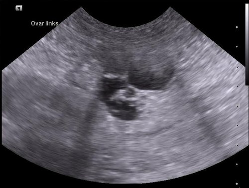 Ultraschall-Bild von Ovarialzysten einer Hündin. (Quelle: Wikipedia) - Foto:©Kalumet/Wikimedia Commons Ultraschall-Bild von Ovarialzysten einer Hündin. (Quelle: Wikipedia) - Foto:©Kalumet/Wikimedia Commons